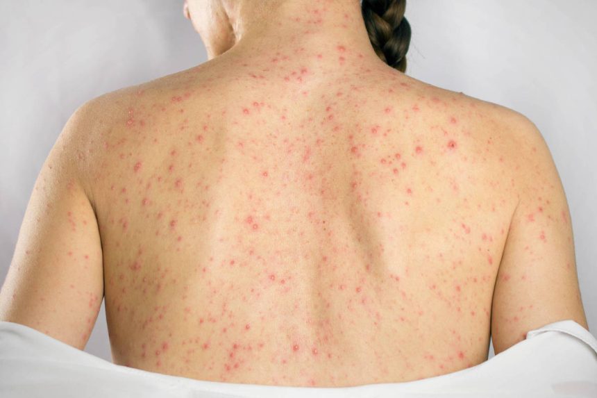 reativacao-do-virus-da-catapora,-herpes-zoster-afeta-principalmente-idosos