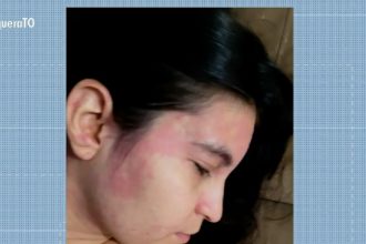 gerente-fica-com-manchas-na-pele-e-olhos-inchados-apos-nadar-no-lago-de-palmas-e-descobre-‘alergia-a-agua’