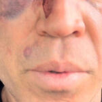 popo-diz-que-passara-por-cirurgia-apos-pancadaria-em-luta-com-wanderlei-silva