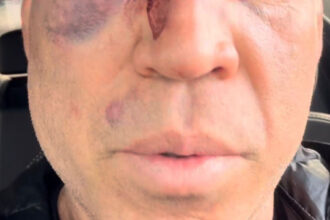 popo-diz-que-passara-por-cirurgia-apos-pancadaria-em-luta-com-wanderlei-silva