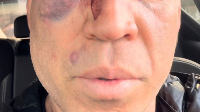 popo-diz-que-passara-por-cirurgia-apos-pancadaria-em-luta-com-wanderlei-silva