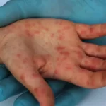 marilia-(sp)-investiga-morte-de-bebe-por-suspeita-de-sarampo