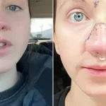 mulher-mostra-rosto-reconstruido-apos-ter-nariz-arrancado-por-cao-nos-eua