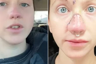 mulher-mostra-rosto-reconstruido-apos-ter-nariz-arrancado-por-cao-nos-eua