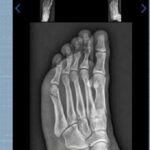 candidato-faz-teste-fisico-da-pm-com-fratura-no-pe-e-consegue-aprovacao:-‘pensei-que-nao-ia-conseguir’