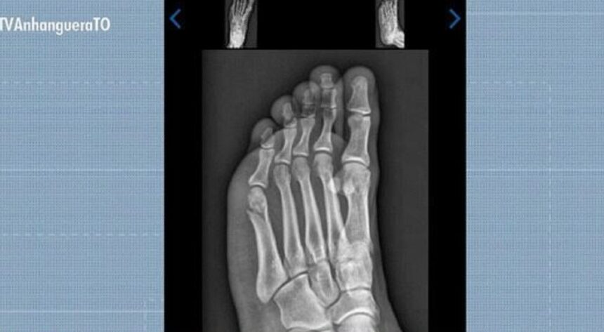candidato-faz-teste-fisico-da-pm-com-fratura-no-pe-e-consegue-aprovacao:-‘pensei-que-nao-ia-conseguir’