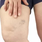 sofre-com-varizes?-conheca-mitos-e-verdades-sobre-a-doenca