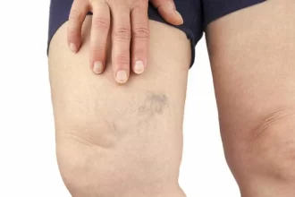 sofre-com-varizes?-conheca-mitos-e-verdades-sobre-a-doenca