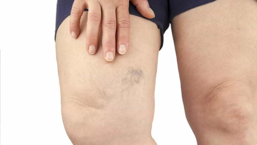 sofre-com-varizes?-conheca-mitos-e-verdades-sobre-a-doenca