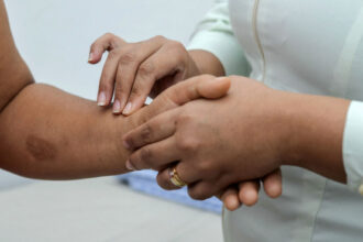 governo-do-tocantins-intensifica-acoes-de-conscientizacao-e-enfrentamento-da-hanseniase-durante-o-janeiro-roxo