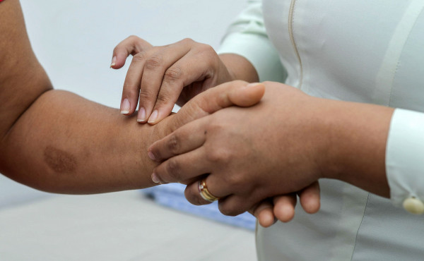 governo-do-tocantins-intensifica-acoes-de-conscientizacao-e-enfrentamento-da-hanseniase-durante-o-janeiro-roxo