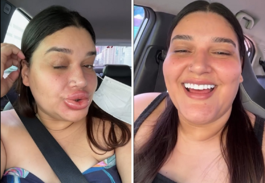 maquiadora-que-ficou-com-labios-gigantes-conta-que-preenchimento-deu-errado:-‘estavam-tortos’