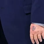 hematoma-misterioso-na-mao-de-trump-volta-a-chamar-a-atencao