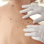 casos-de-cancer-de-pele-saltam-de-4-mil-para-mais-de-72-mil-em-10-anos