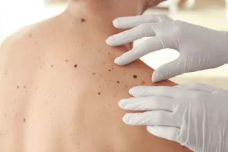 casos-de-cancer-de-pele-saltam-de-4-mil-para-mais-de-72-mil-em-10-anos