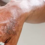 hanseniase:-brasil-registrou-mais-de-300-mil-casos-da-doenca-em-dez-anos