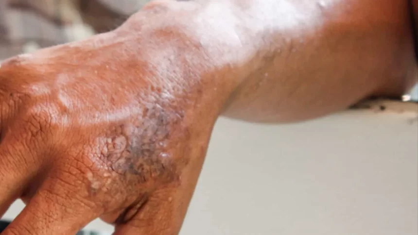 hanseniase:-brasil-registrou-mais-de-300-mil-casos-da-doenca-em-dez-anos