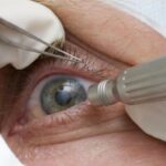 lula-faz-cirurgia-de-catarata;-entenda-a-doenca-e-o-procedimento