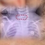 como-‘punicao’,-mulher-fere-600-vezes-bebe-com-agulha,-que-acaba-presa-na-coluna-cervical-da-crianca