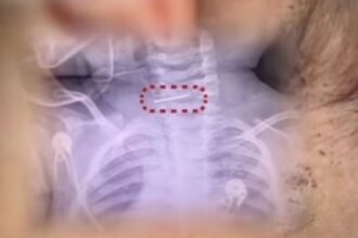 como-‘punicao’,-mulher-fere-600-vezes-bebe-com-agulha,-que-acaba-presa-na-coluna-cervical-da-crianca