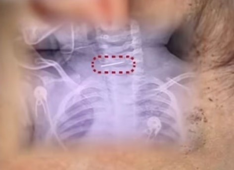 como-‘punicao’,-mulher-fere-600-vezes-bebe-com-agulha,-que-acaba-presa-na-coluna-cervical-da-crianca