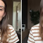 atriz-descobre-cancer-raro-na-mama-causado-por-protese-de-silicone