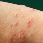 mpox:-nova-recombinacao-de-cepas-e-identificada-pela-oms