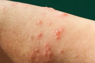 mpox:-nova-recombinacao-de-cepas-e-identificada-pela-oms