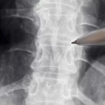 neurologistas-alertam-para-falta-de-evidencias-sobre-acao-da-polilaminina-em-lesao-medular