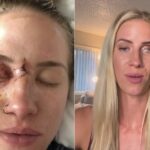 esquiadora-conta-detalhes-de-como-perdeu-olho-apos-ser-atingida-por-galho-de-arvore