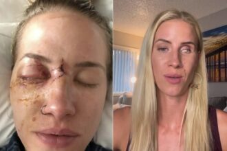 esquiadora-conta-detalhes-de-como-perdeu-olho-apos-ser-atingida-por-galho-de-arvore