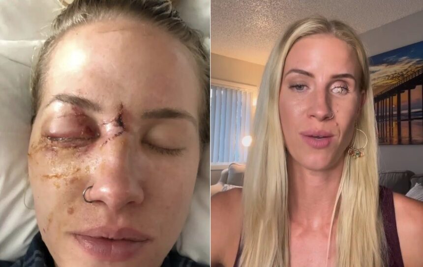 esquiadora-conta-detalhes-de-como-perdeu-olho-apos-ser-atingida-por-galho-de-arvore