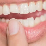 quebrou-o-dente?-o-que-fazer-nos-primeiros-minutos-para-salvar-o-sorriso?