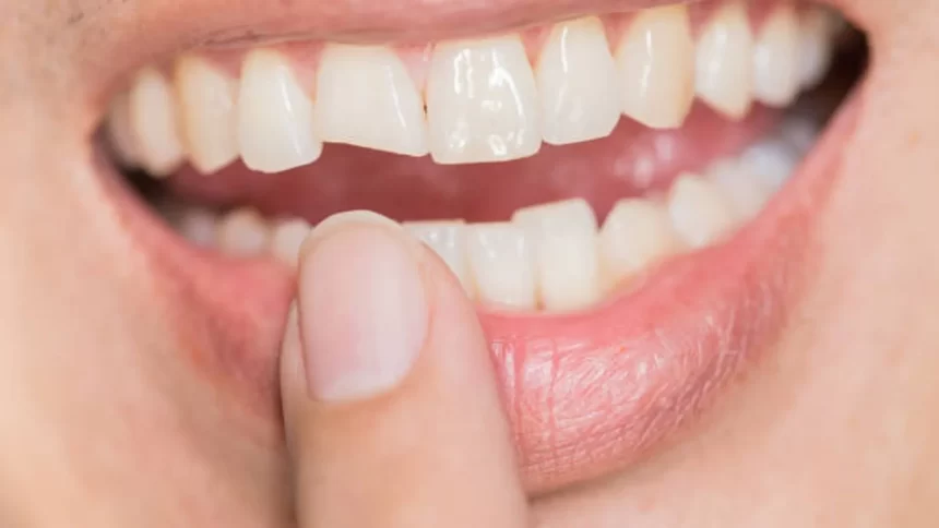 quebrou-o-dente?-o-que-fazer-nos-primeiros-minutos-para-salvar-o-sorriso?