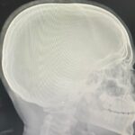 estudante-tem-nariz quebrado apos-sofrer-ofensas-racistas-e-agressao-em-escola-publica-do-tocantins