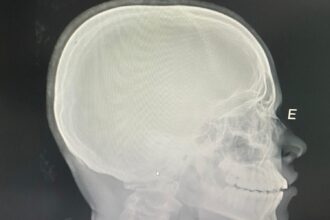 estudante-tem-nariz quebrado apos-sofrer-ofensas-racistas-e-agressao-em-escola-publica-do-tocantins