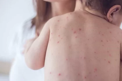 sao-paulo-tem-primeiro-caso-de-sarampo-em-2026