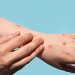 brasil-chega-a-140-casos-confirmados-de-mpox-em-2026