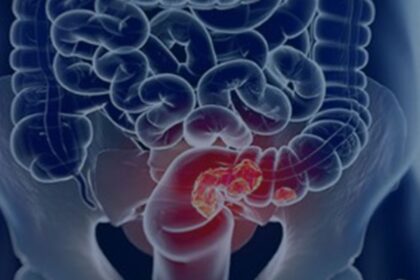 sus-adota-novo-exame-para-rastrear-cancer-colorretal-na-populacao
