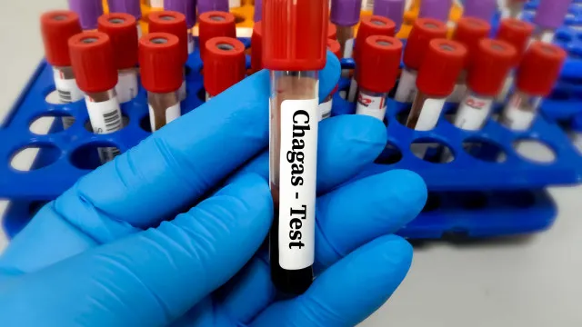 risco-cardiaco-dobra-para-pacientes-com-doenca-de-chagas-apos-cirurgia