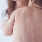 apos-casos-de-sarampo,-ministerio-da-saude-recomenda-vacinar-bebes
