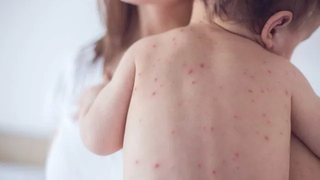 apos-casos-de-sarampo,-ministerio-da-saude-recomenda-vacinar-bebes