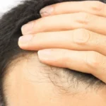 cabelo-transplantado-pode-cair?-veja-alguns-detalhes-sobre-o-procedimento