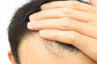cabelo-transplantado-pode-cair?-veja-alguns-detalhes-sobre-o-procedimento
