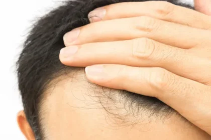 cabelo-transplantado-pode-cair?-veja-alguns-detalhes-sobre-o-procedimento