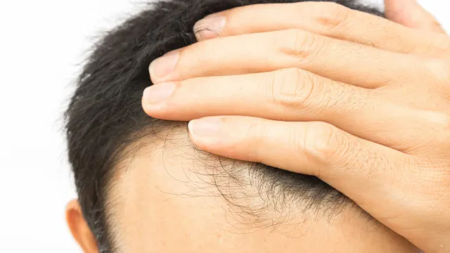 cabelo-transplantado-pode-cair?-veja-alguns-detalhes-sobre-o-procedimento