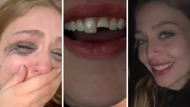 jovem-quebra-dente-na-balada-no-pr,-cola-na-madrugada-e-volta-para-a-festa