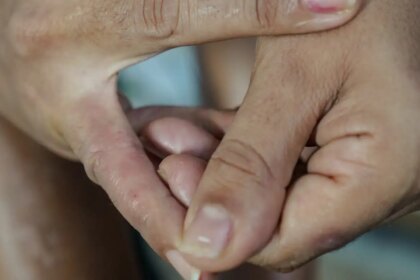 dermatite-atopica-impacta-pele,-sono-e-autoestima:-saiba-como-tratar