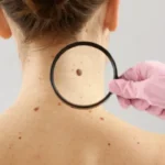 cancer:-estudo-alerta-para-riscos-de-melanoma-fora-da-pele