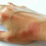 anvisa-aprova-novo-medicamento-para-tratar-lupus